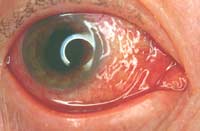 conjunctivitis.jpg
